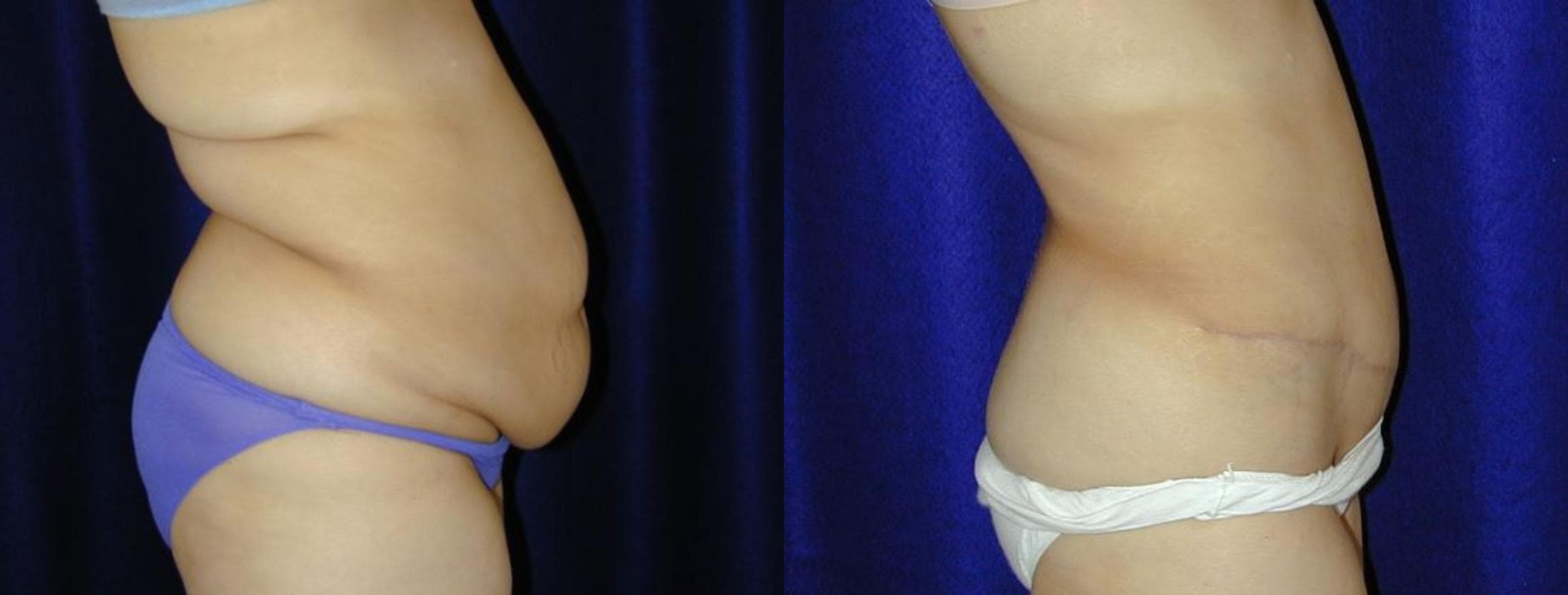 Abdominoplasty Before and After