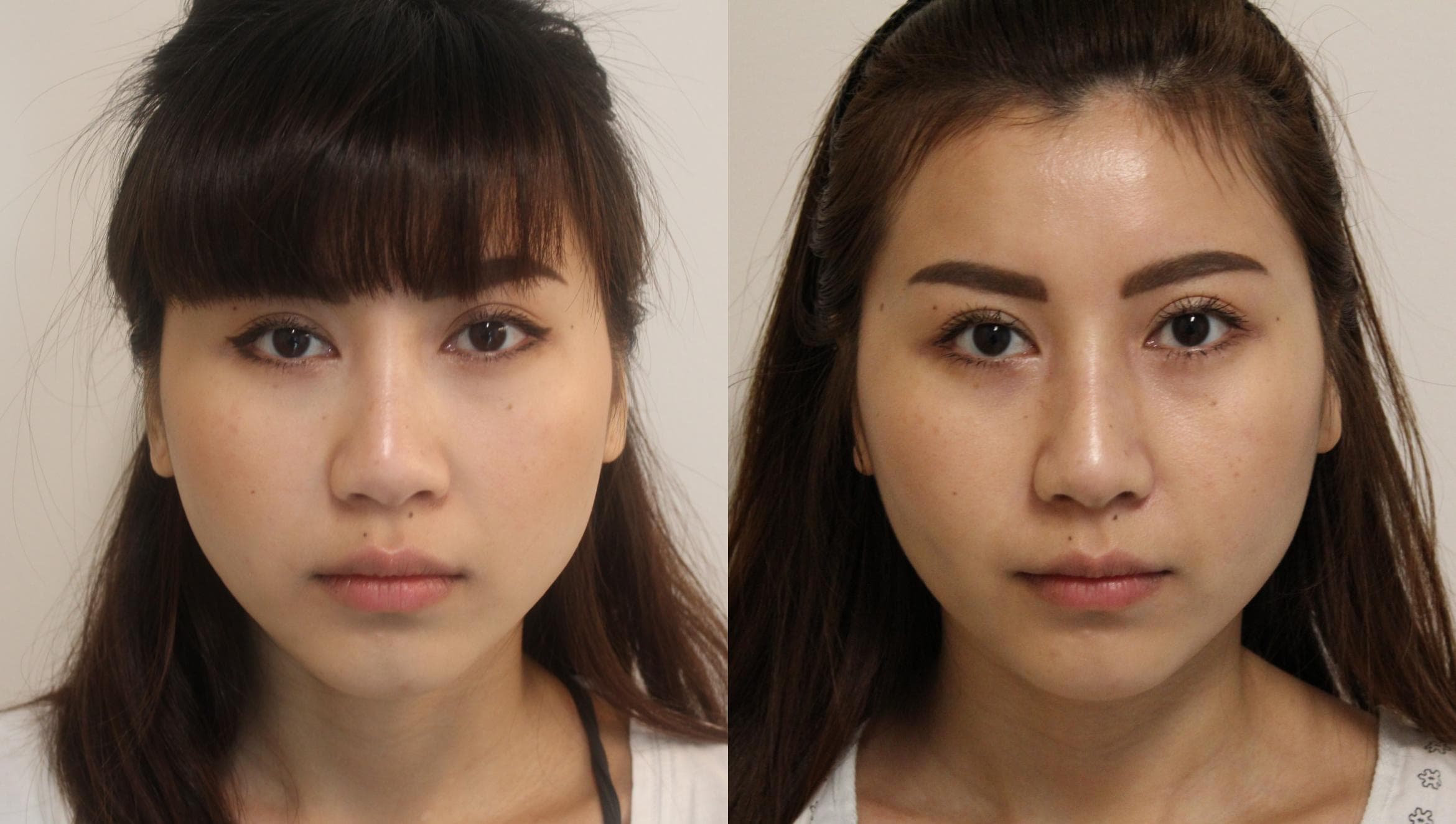 Asian Rhinoplasty Before and After