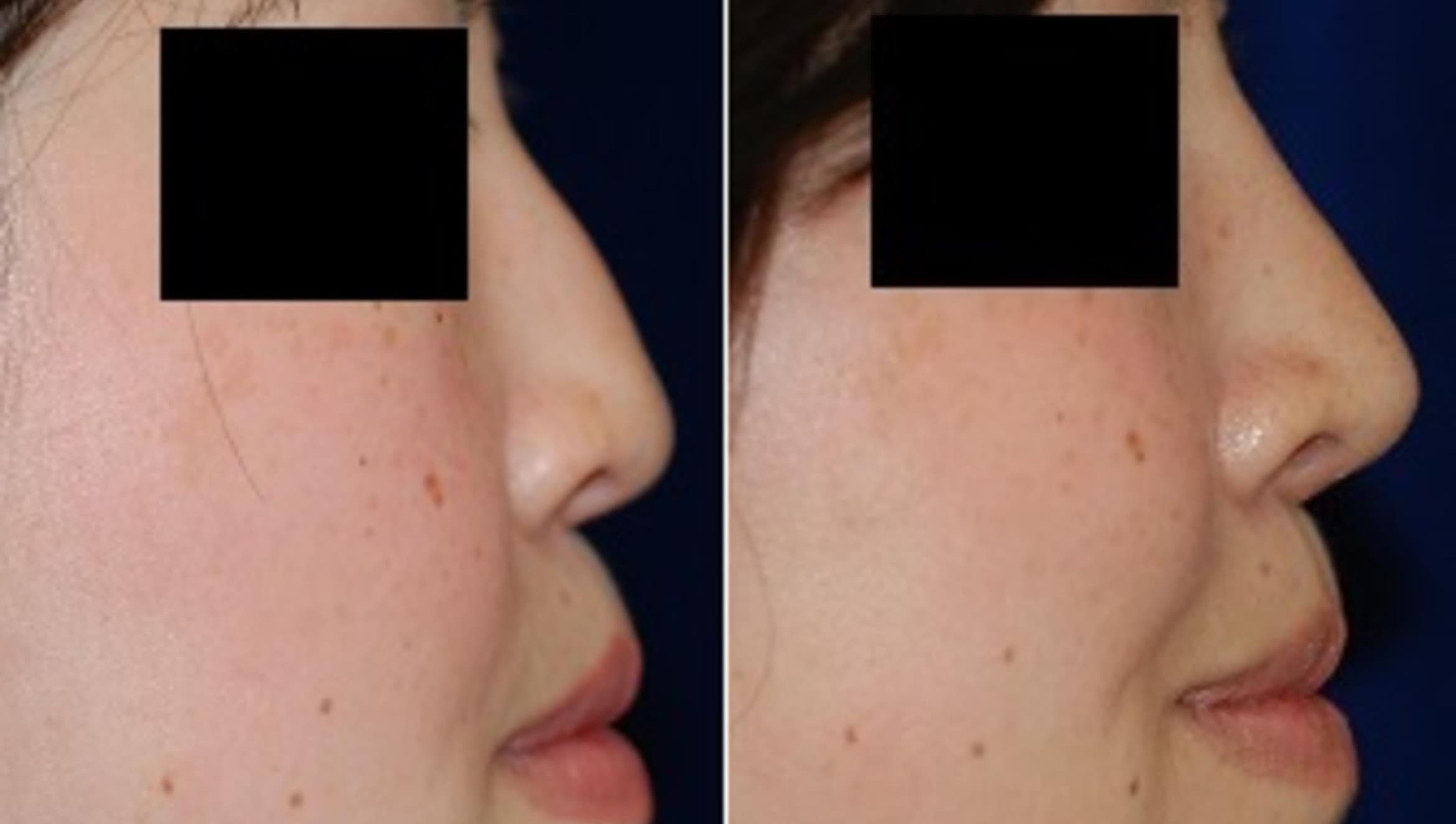 Asian Rhinoplasty Before and After