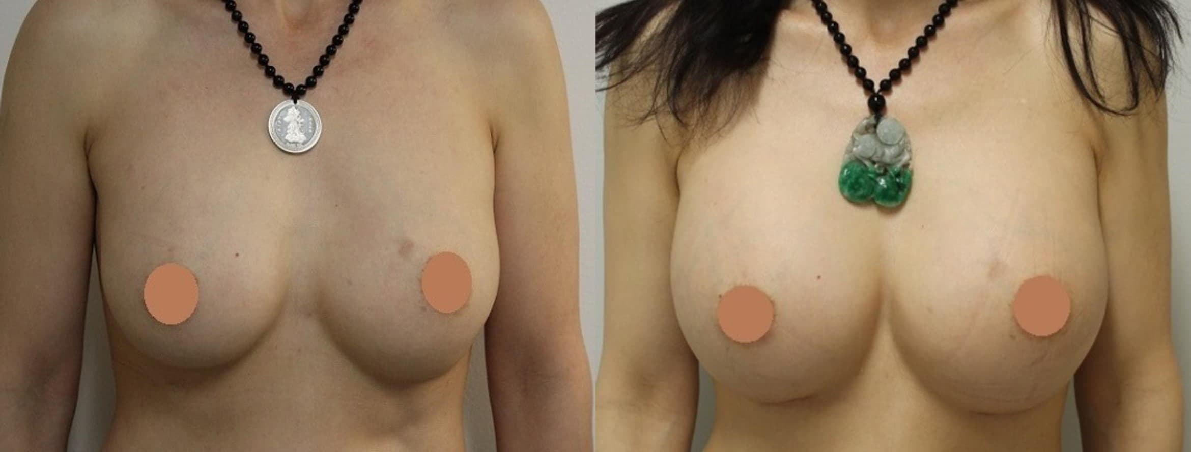 Breast Augmentation Before and After