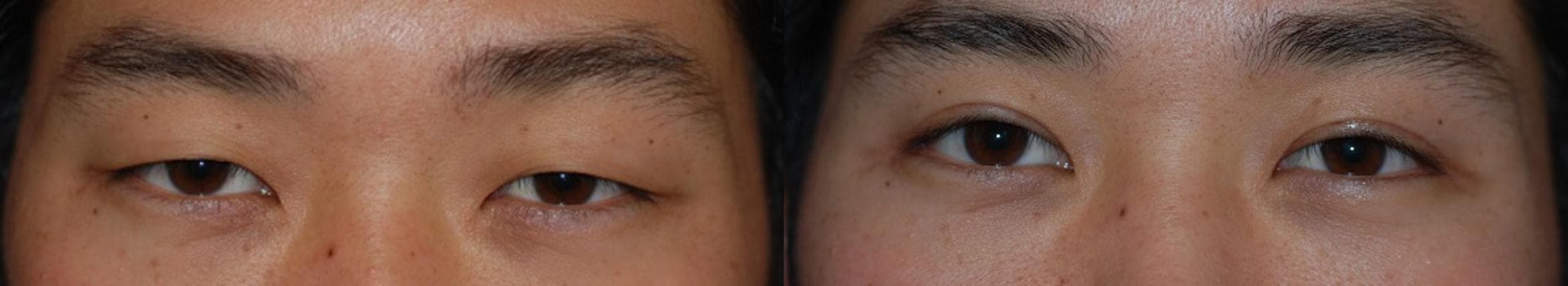 Eyelid Surgery Before and After