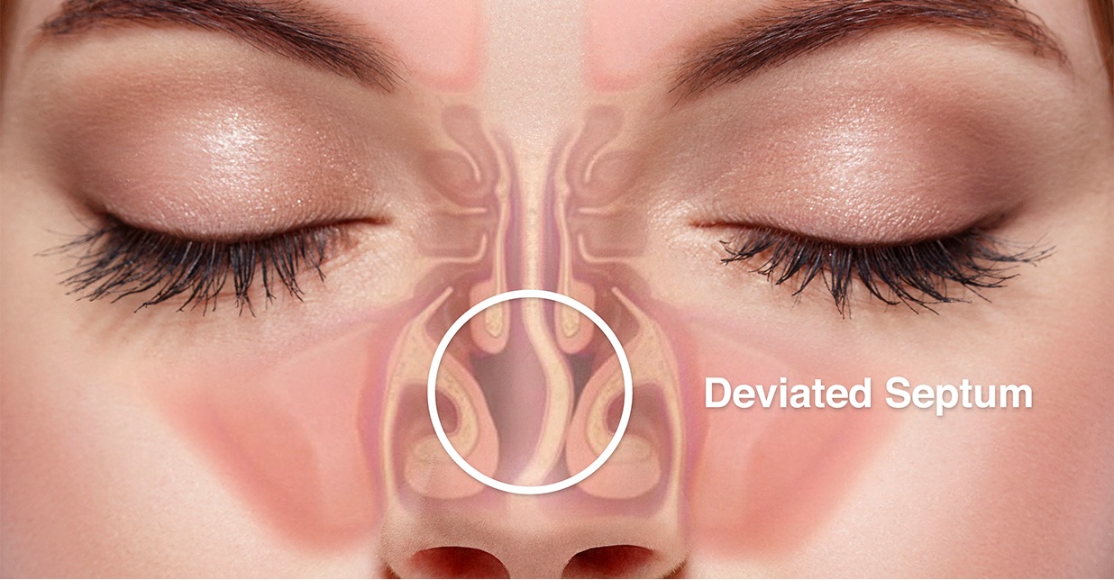 Illustration of a Deviated Septum