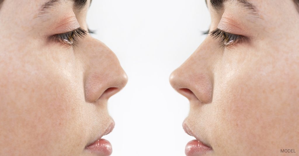 before and after image of a woman's revision rhinoplasty procedure (model)